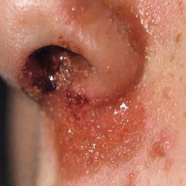 impetigo contagiosa