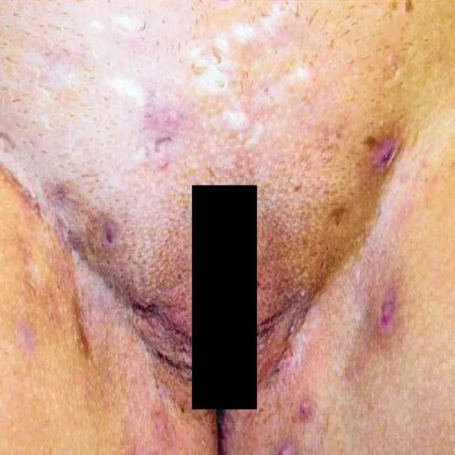 infekcja intymna  ropne zapalenie apokrynowych gruczołów potowych