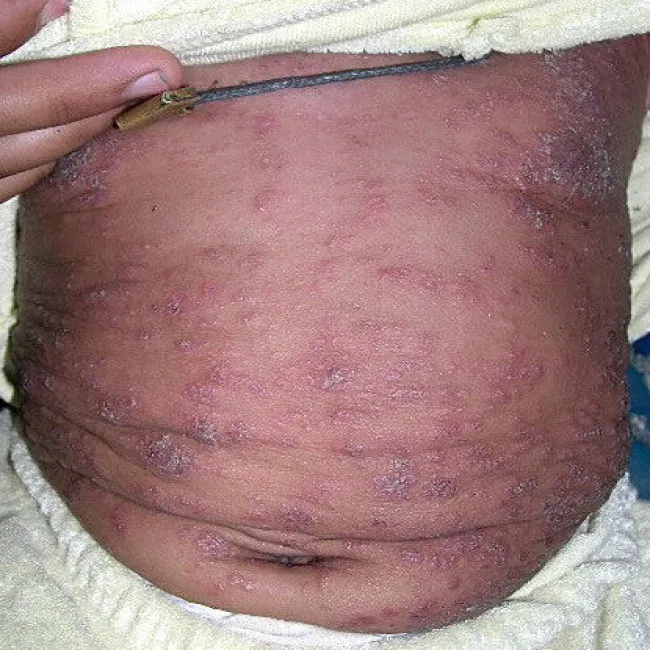 jak wygląda świerzb u dzieci 