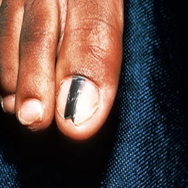 jak wygląda czerniak na paznokciu