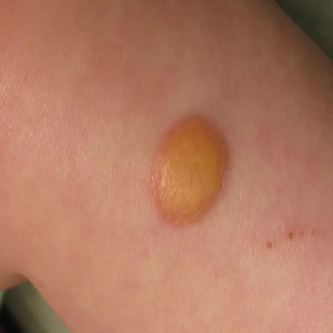 juvenile xanthogranuloma 