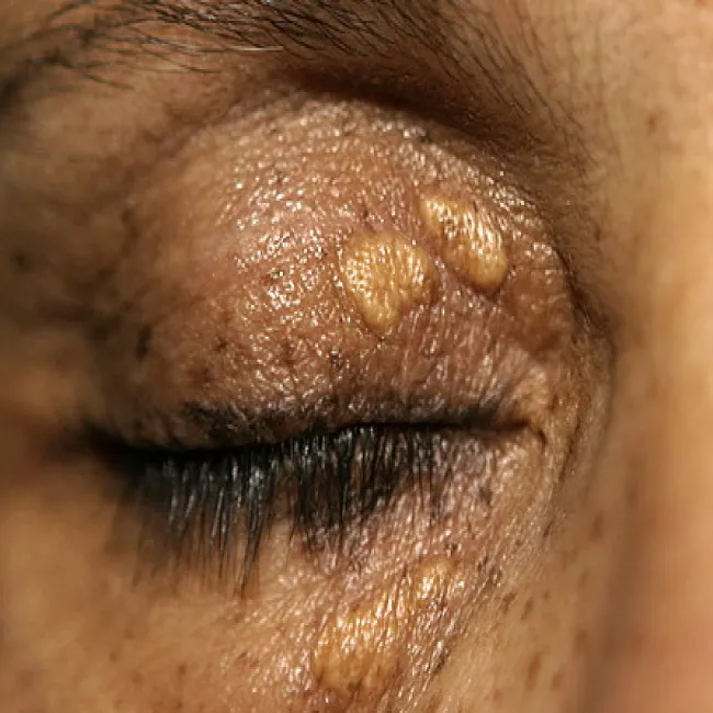 kępki żółte powiek 