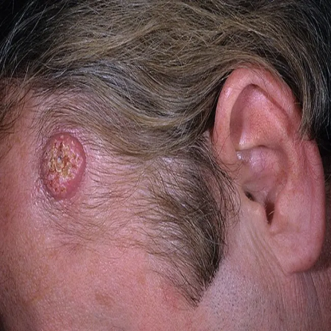 keratoacanthoma zdjęcie