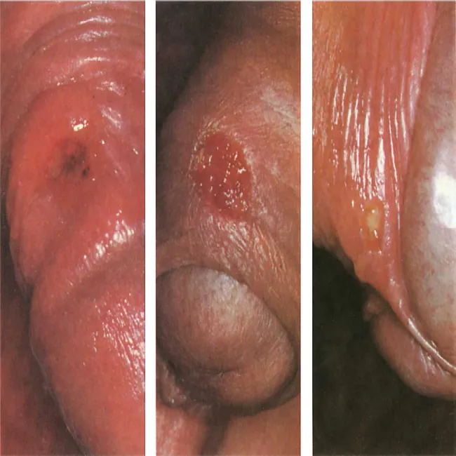  Kiła pierwotna twarde wrzody 