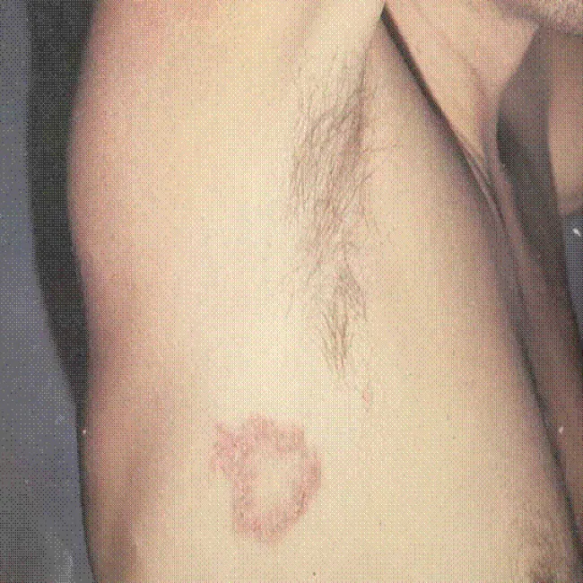 kiła trzeciorzędowa zdjęcie