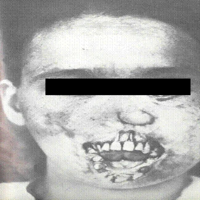 kiła wrodzona deformacja twarzy