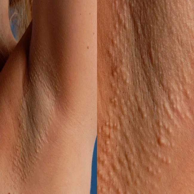 krosty pod pachami choroba Foxa-Fordyce'a