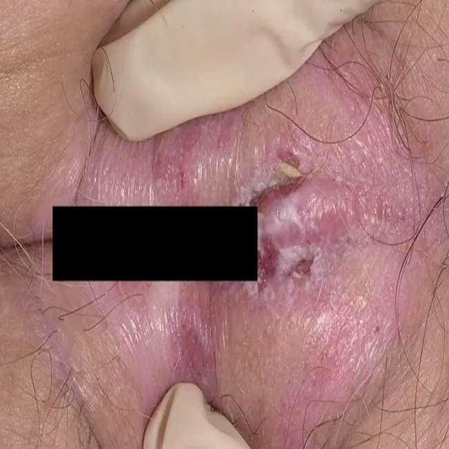 leukoplakia narządów płciowych