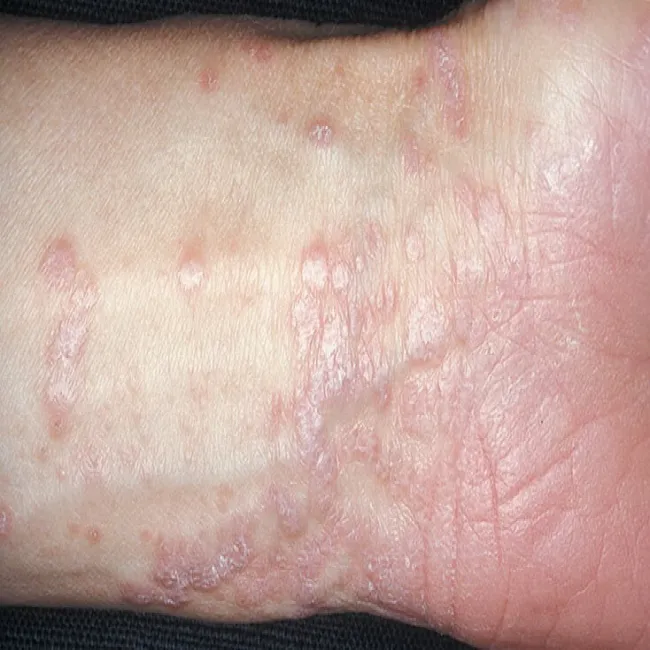 lichen planus