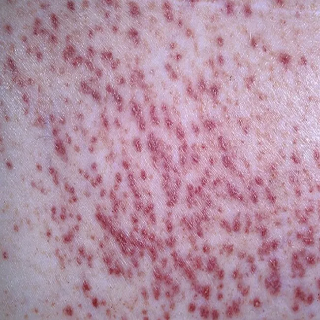 liszaj płaski mieszkowy