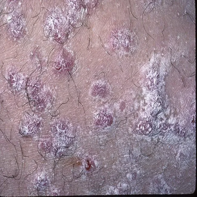 liszaj płaski nadżerkowy