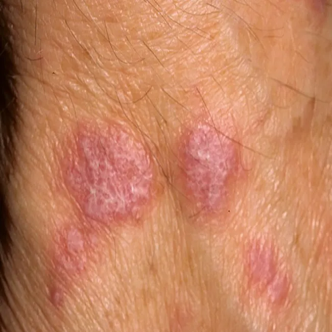 liszaj płaski skóry