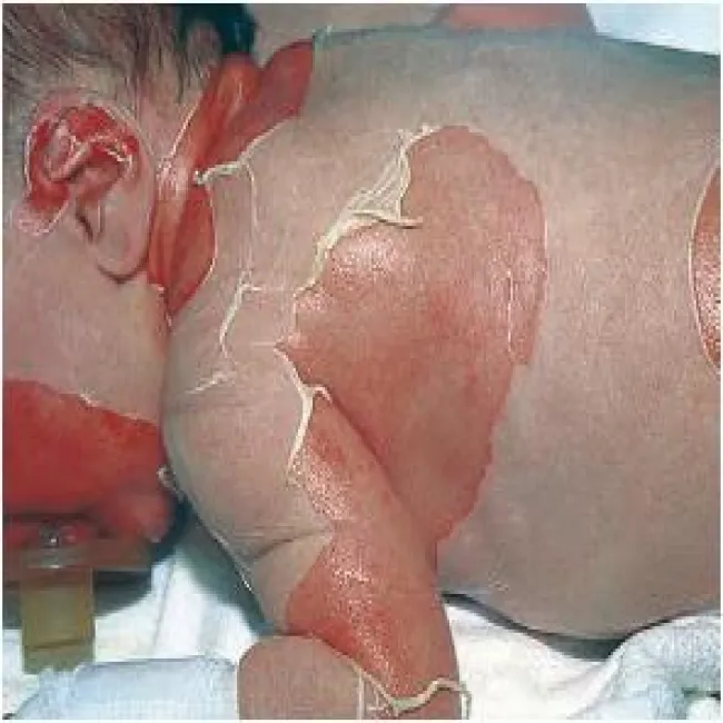 liszajec pęcherzowy noworodków