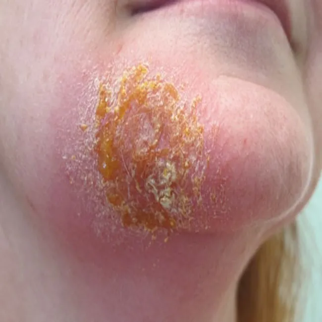 liszajec zakaźny na twarzy