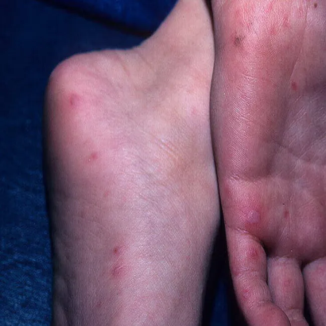 małe czerwone plamki na stopach i dłoniach 