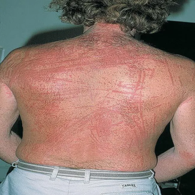 mechaniczne podrażnienie skóry dermografizm 