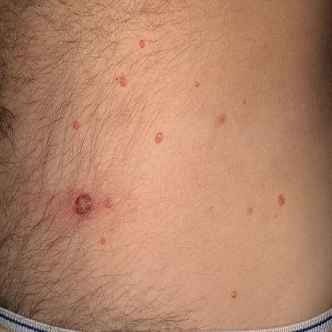 mięczak zakaźny na tułowiu