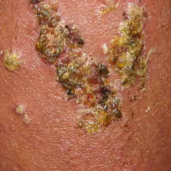  miodowo żółte strupy liszajec