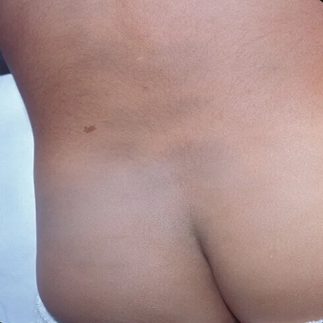 mongolian spot 