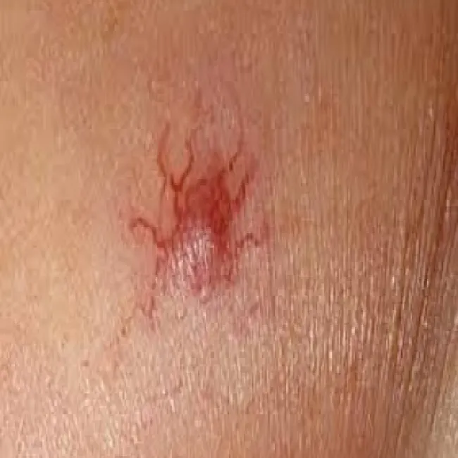 naczyniaki gwiaździste