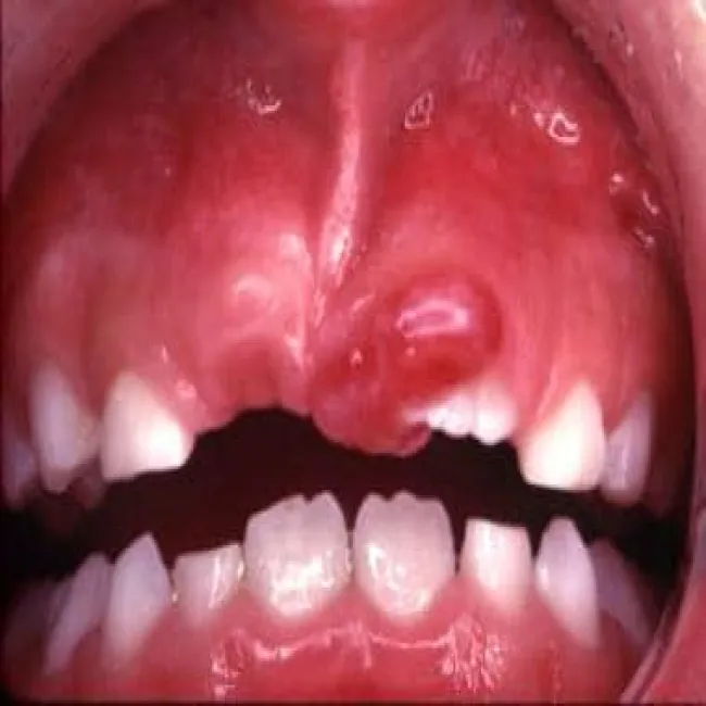 nadziąślak u dzieci 