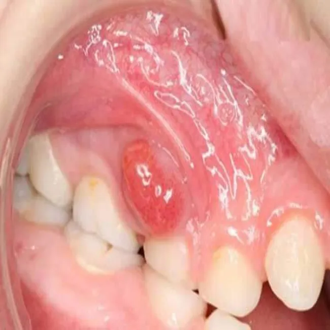 nadziąślak u dziecka