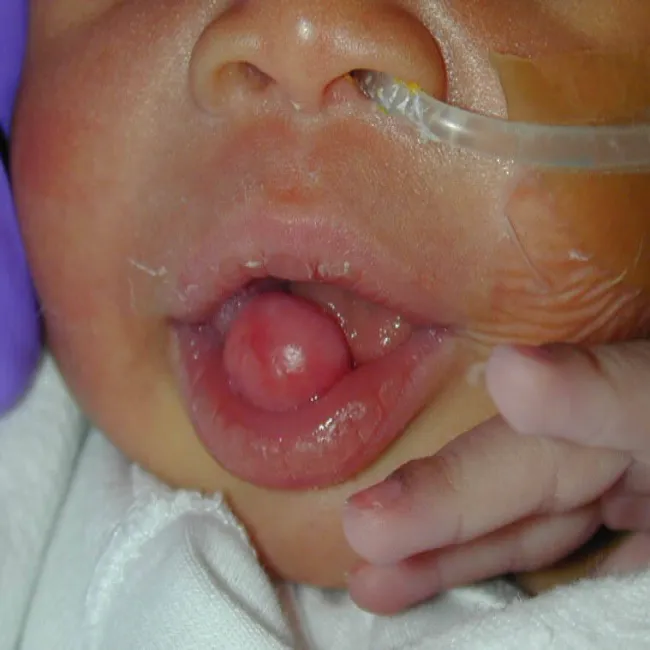 nadziąślak u niemowlaka