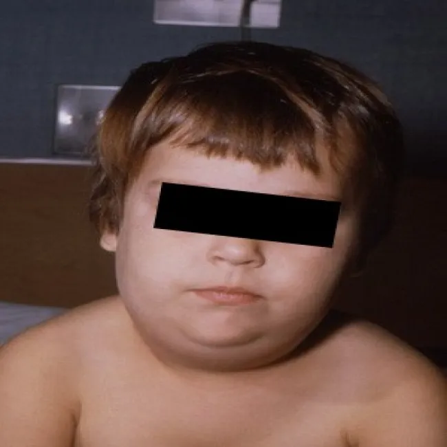 nagminne zapalenie przyusznic u dzieci