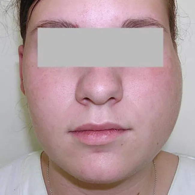 nagminne zapalenie przyusznic