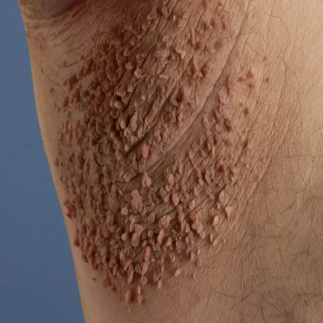 narośl pod pachą włókniaki miękkie 