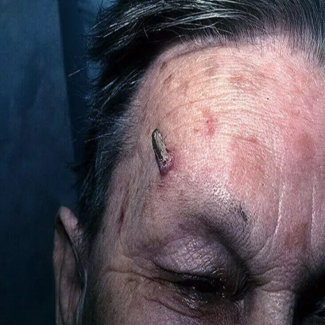 narośl skórna na czole