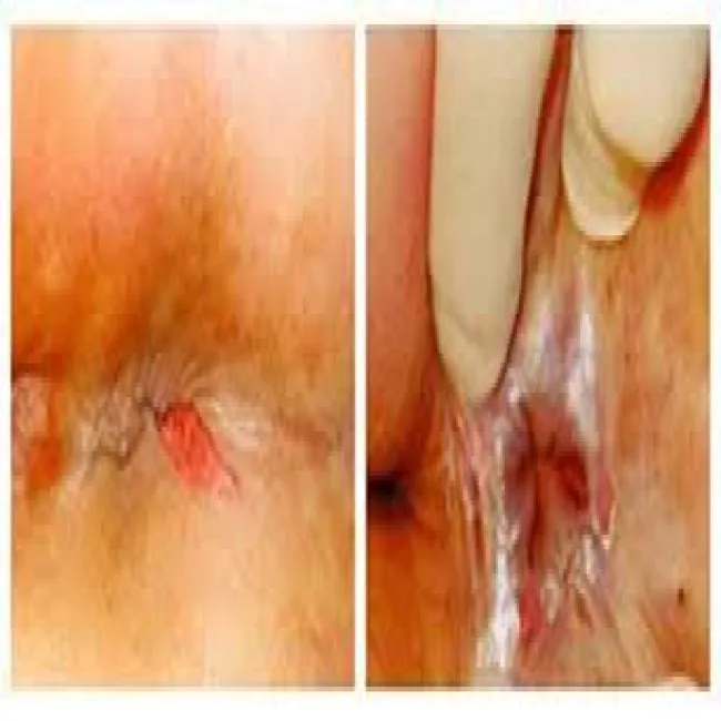 niegojąca się rana przy odbycie