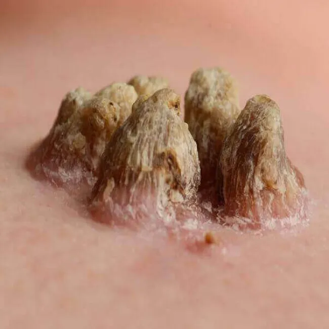 niewielki wzrost skóry