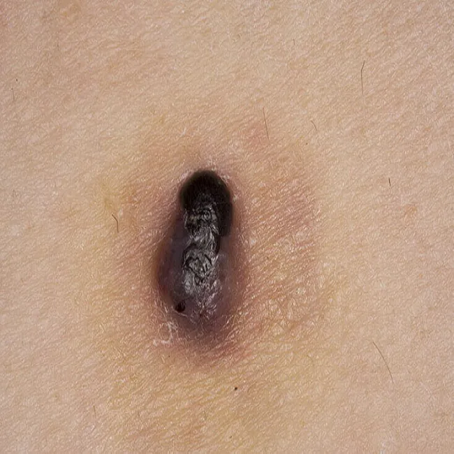 nodular melanoma