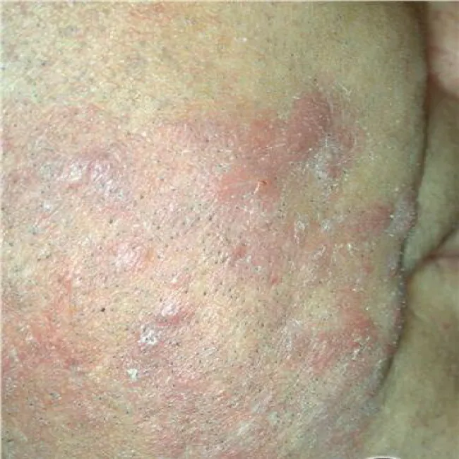 nużeniec ludzki na skórze