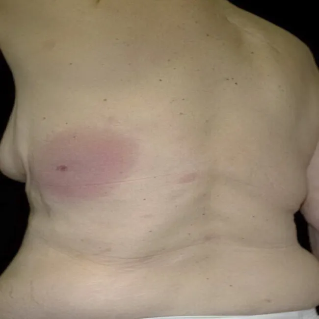 objawy boreliozy u ludzi zdjęcia