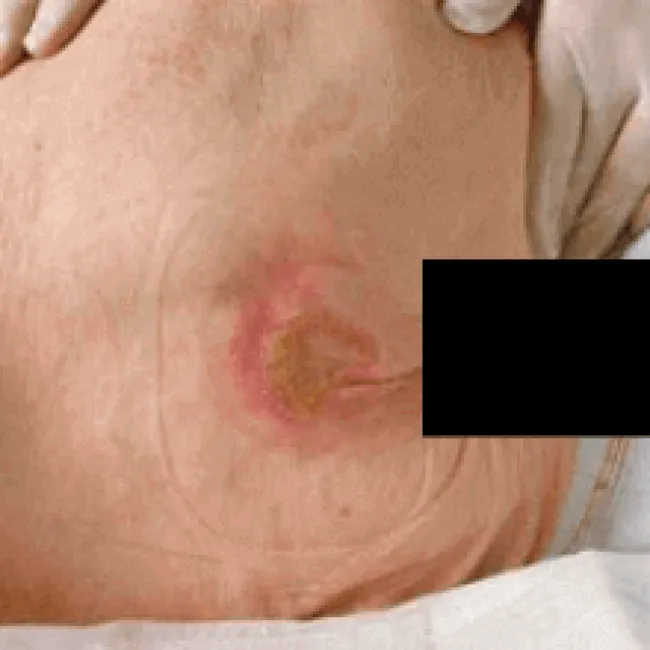 odleżyna na kości ogonowej