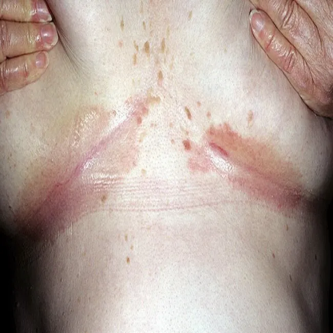 odparzenia pod biustem zdjęcia