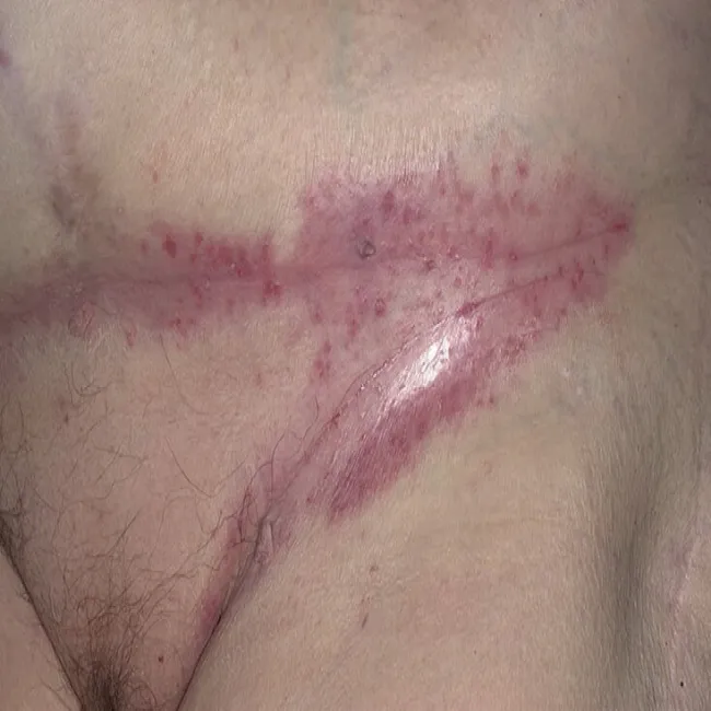 odparzenia skóry w pachwinach u dorosłych