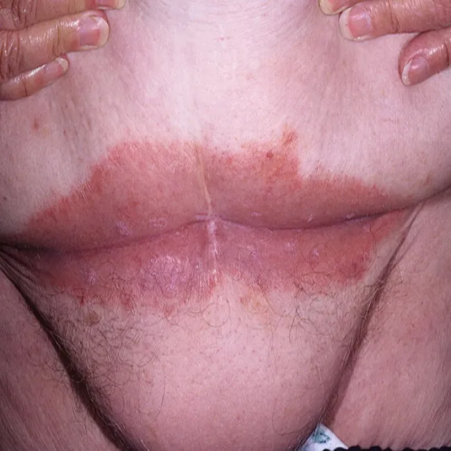 odparzenia w fałdach skórnych