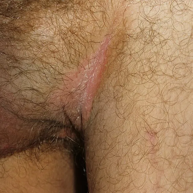 odparzenia w okolicach intymnych