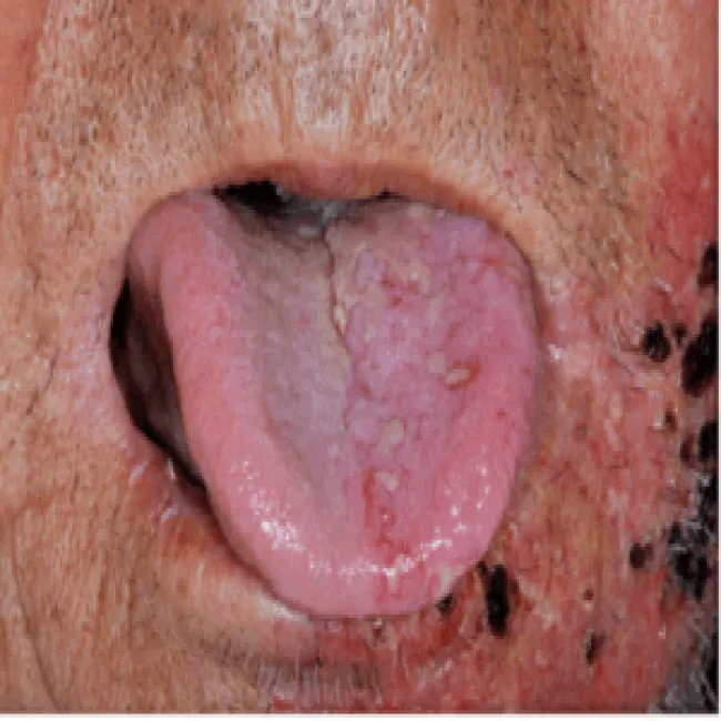 półpasiec na języku