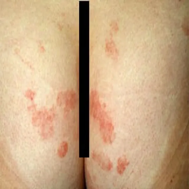 półpasiec na pośladkach