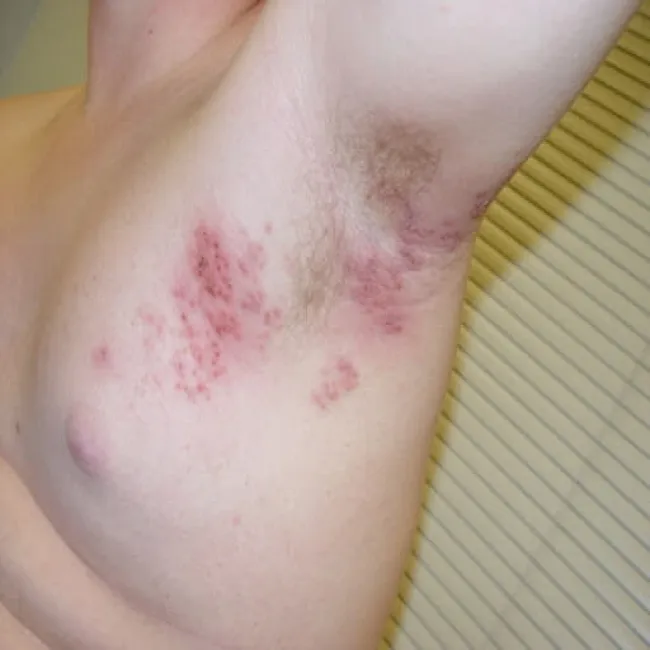 półpasiec pod pachą