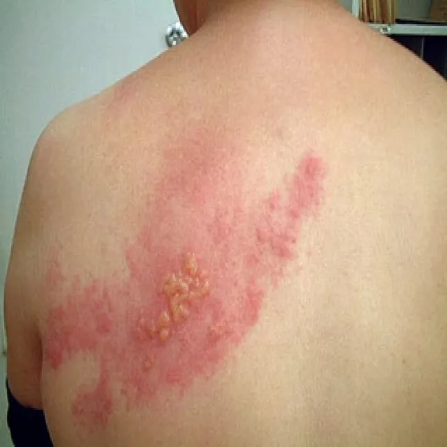 półpasiec zdjęcia