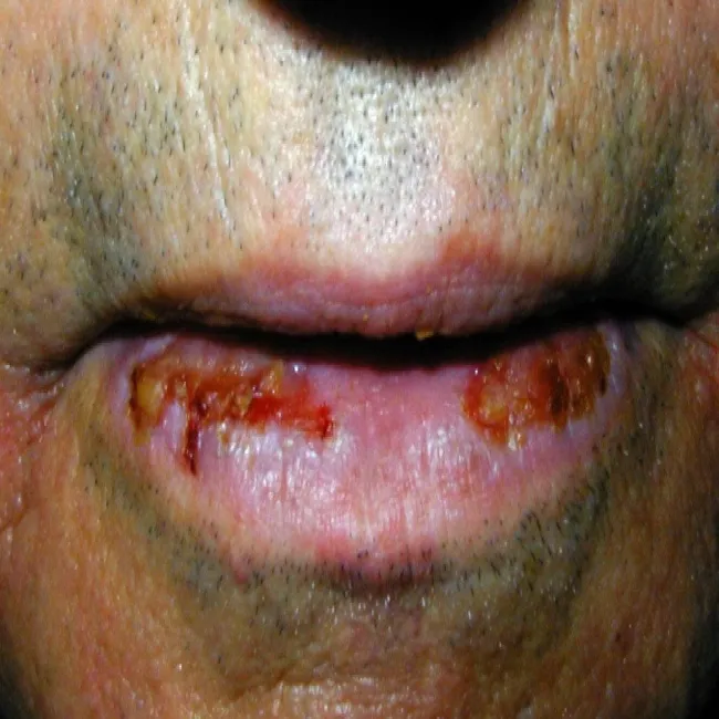 pęcherzyca zwykła na ustach