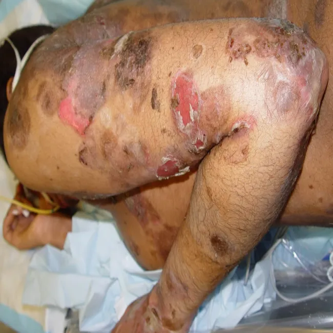 pęcherzyca zwykła skórna