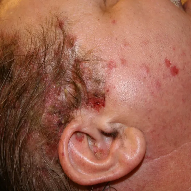 pęcherzyca zwykła u dziecka