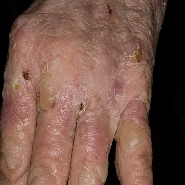 pęcherzyki na dłoniach zdjęcia