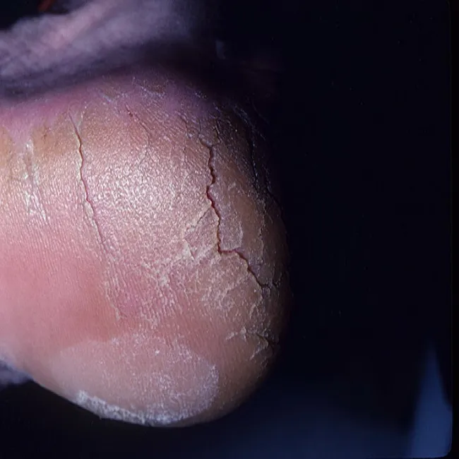 pękająca skóra na piętach